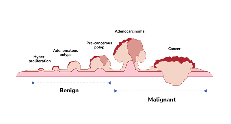 Fecal DNA Testing is a Key Tool for Early Detection of Colorectal Cancer