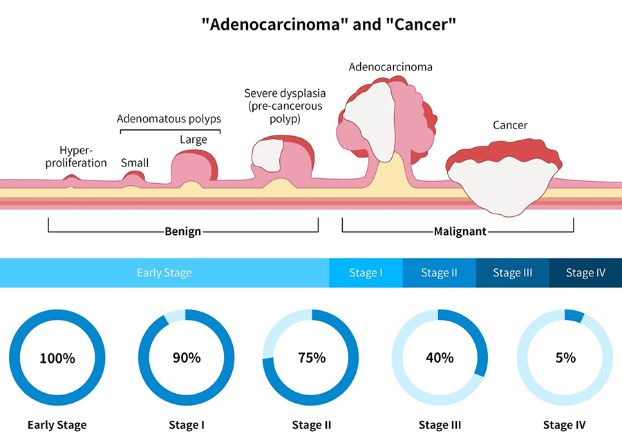 As colorectal cancer for the under 50s rises, regular screening is ...